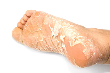 Cracked skin on heels.