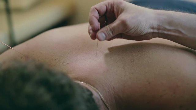 Doctor's hand touching acupuncture needle that sticking in the back of the patient.