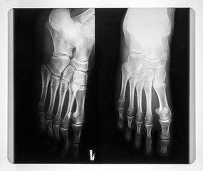 X-ray of the feet