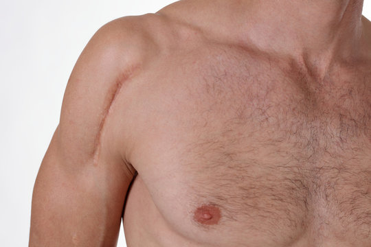 Man man with scar on his shoulder close up isolated on white background. Laser Scar Reduction concept