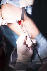 Surgical operation knee surgery