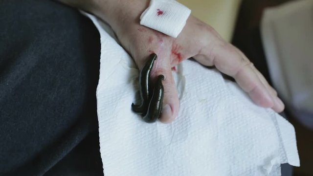 Two medical leeches are sucking blood from a man's hand.