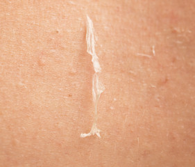 Fototapeta premium skin peeling after sunburn