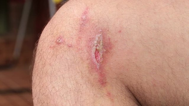 Irritant contact dermatitis at man leg, close up.. Pederus-dermatitis - Allergic reaction to the blood type of beetles Paederus, characterized by vesicular dermatitis
