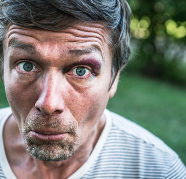 Portrait of man with black eye looking at camera pulling face