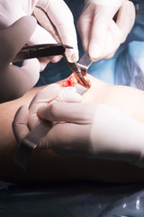 Surgical operation knee surgery