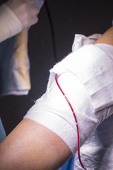 Bandaging post knee surgery