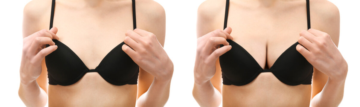 Woman breast before and after size correction. Plastic surgery concept.