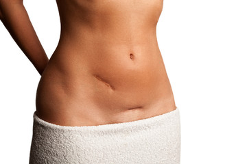 Narbe am bauch bikini