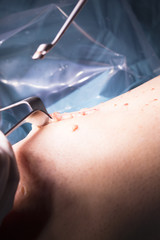 Surgical operation knee surgery