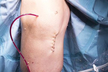 Surgical operation knee surgery