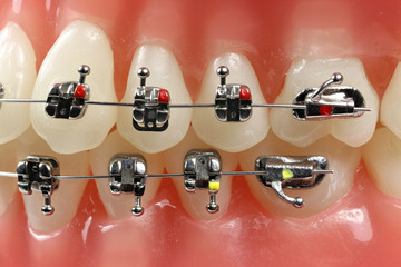 tooth model with metal wired dental braces