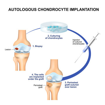 Autologous Chondrocyte Implantation