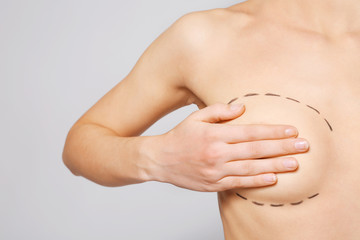 Closeup view of young woman with breasts marked for plastic operation, on light background