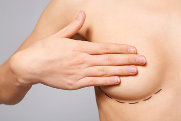 Closeup view of young woman with breasts marked for plastic operation, on light background