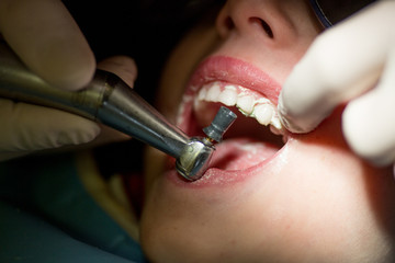 Teeth polishing procedure, dentistry