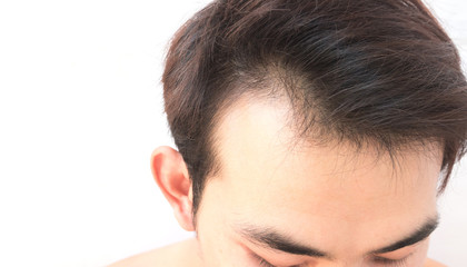 Fototapeta premium Young man worry hair loss problem for health care shampoo and be