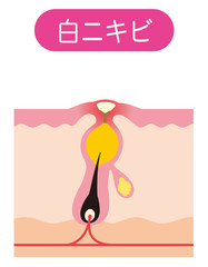 白ニキビ　ニキビの仕組み　毛穴の構造