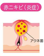 赤ニキビ　ニキビの仕組み　毛穴の構造