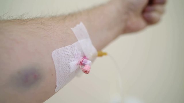 Patient PoV: Male hand with IV catheter closeup. A person receiving medication via intravenous therapy.
