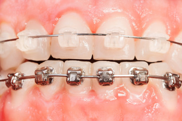 Fototapeta premium Tooth alignments with ceramic and metal braces