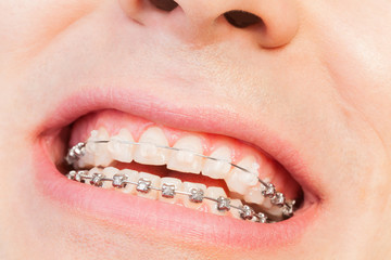 Man's smile with orthodontic braces