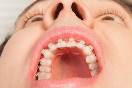 Man's wide opened mouth with dental braces