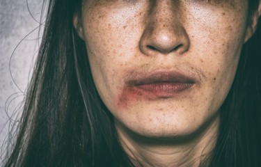 woman being abuse, bruised on face with black shadow