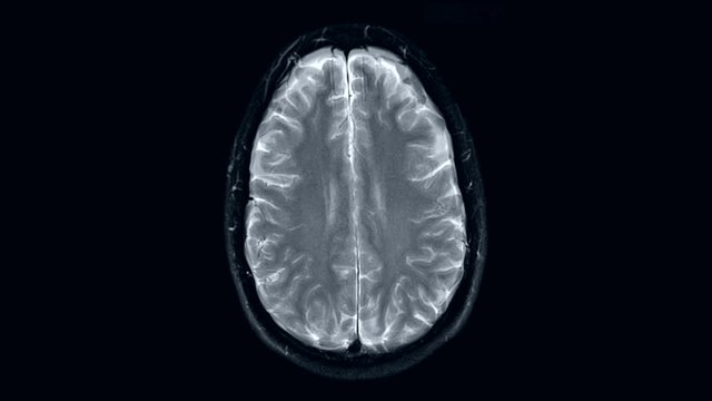 magnetic resonance imaging, MRI MRT head, top view