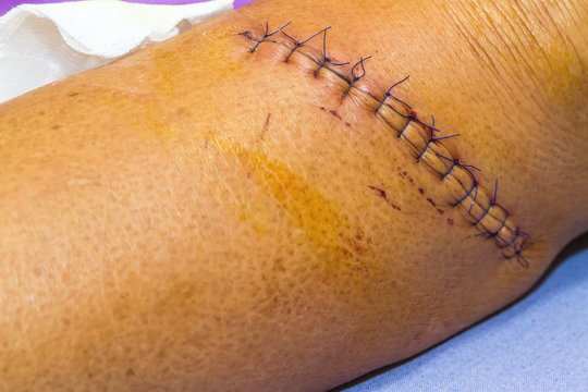 scar from operation suture with a blue fiber at leg patient