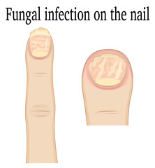 Fungal infection on the fingers of the feet and hands