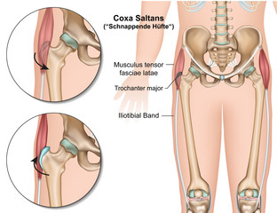 Coxa saltans, schnappende Hüfte medical vector  illustration 