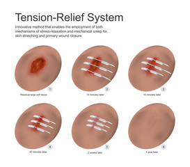 tension relief system