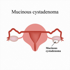 Mucinous cyst on the ovary. Cystadenoma. . Infographics. Vector illustration