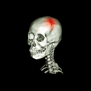Stroke . CT scan with 3D image of human skull and cervical spine . oblique view .