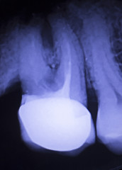 Tooth filling dental xray