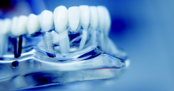 Dentists dental teeth implant