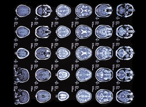 X-ray image of the brain computed tomography