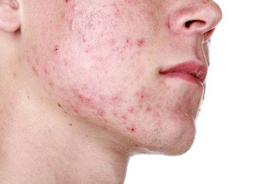 Severe Acne