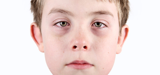 Boy with allergic shiners - obrazy, fototapety, plakaty