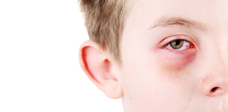 Boy with an injured eye