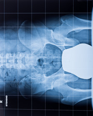 Röntgenaufnahme einer menschlichen Hüfte