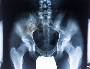 Röntgenaufnahme einer menschlichen Hüfte