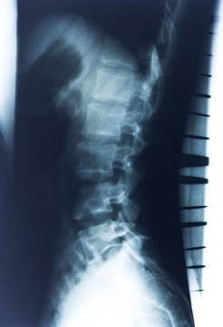 Röntgenbild einer menschlichen Wirbelsäule