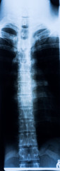 Röntgenbild einer menschlichen Wirbelsäule