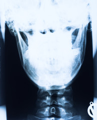 Röntgenbild eines menschlichen Gesichts mit Kiefer und Halswirbelsäule