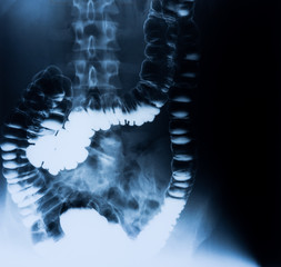 Röntgenaufnahme des Darms frontal - intestinum