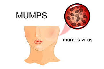 illustration of a child affected by mumps. virus