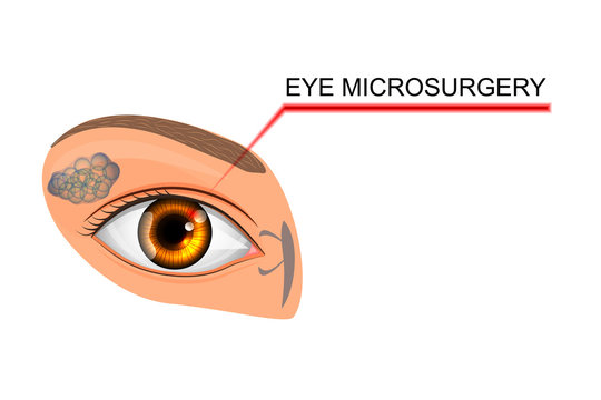 illustration of the eye, the eyeball. microsurgery in ophthalmol