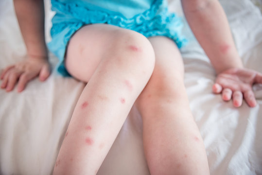Mosquito bites sore and scar on child legs